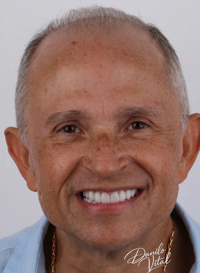 Paciente sorrindo no caso de precisão estética