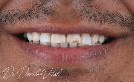 Sorriso antes do tratamento apresentado